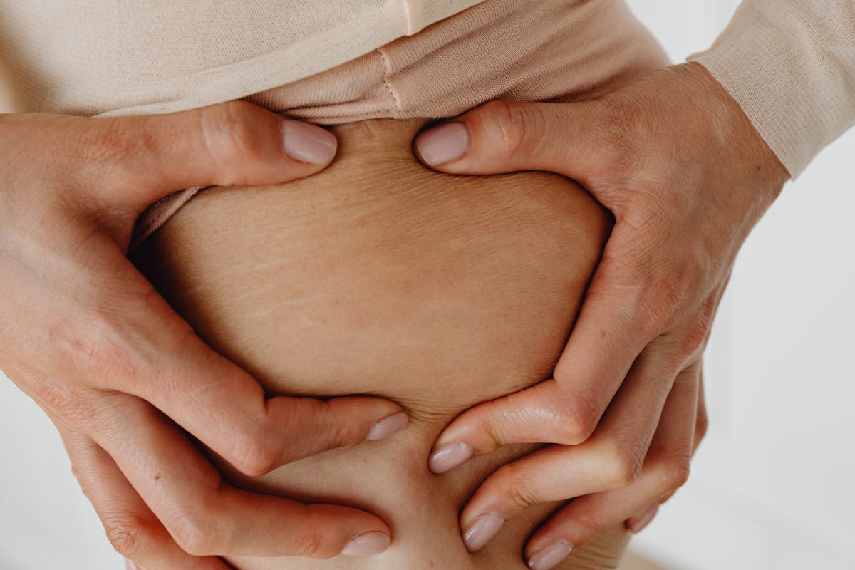 woman with stretch marks holding skin