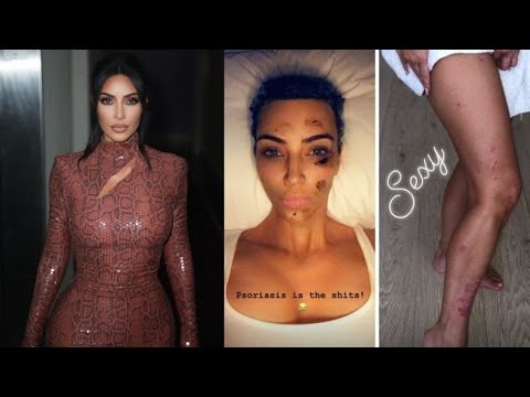 kim kardashian psoriasis