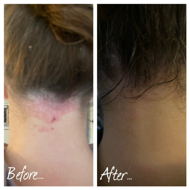 before and after from using our hair and scalp oil