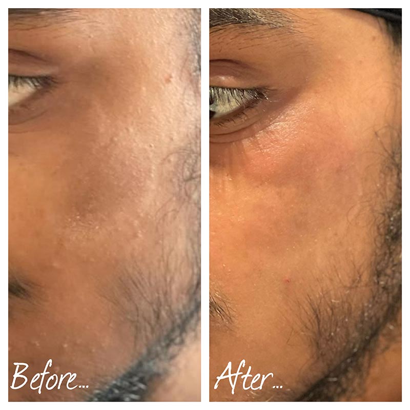 results from using dusk on acne on the face