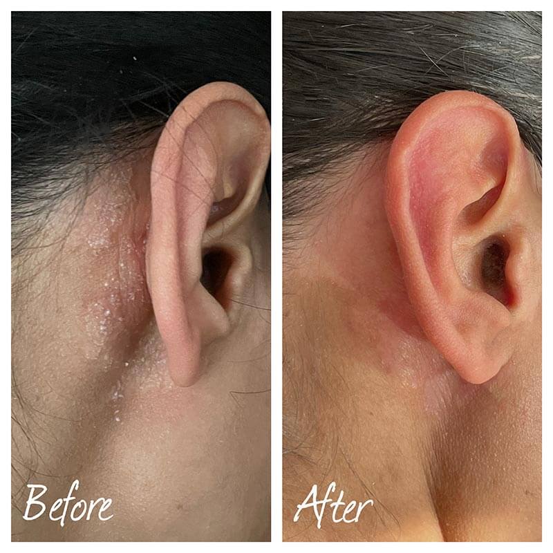 scalp psoriasis is healed from using so sona skincare scalp oil